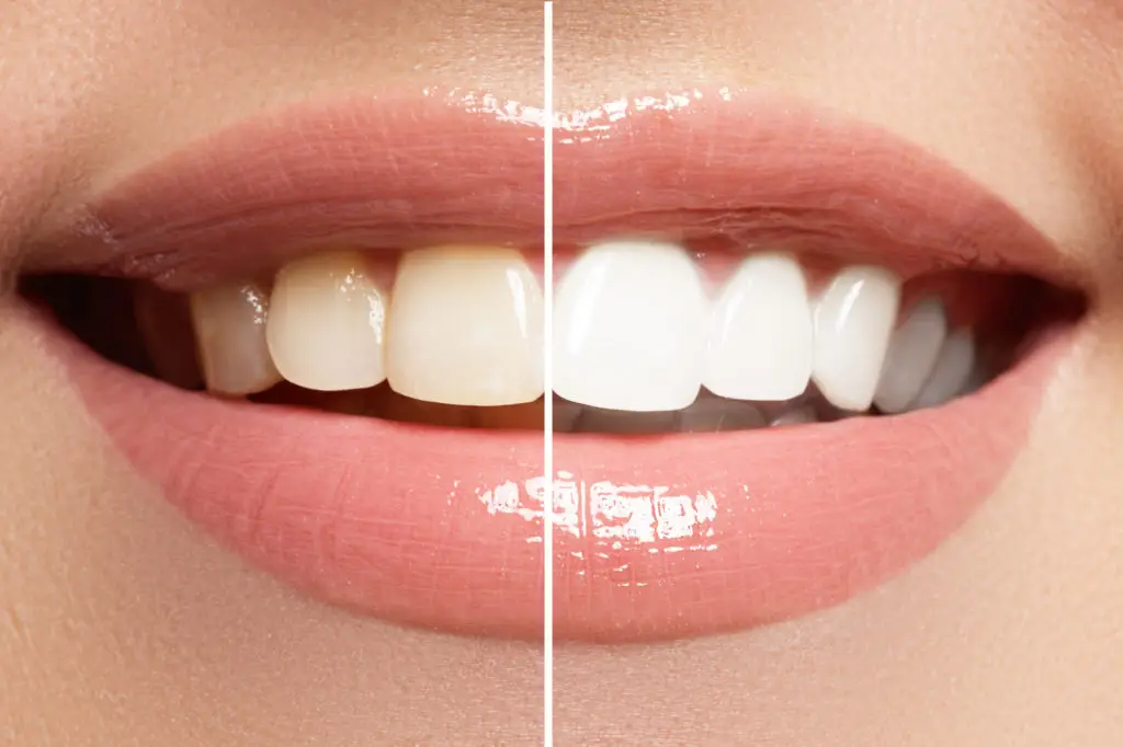 whiten your teeth