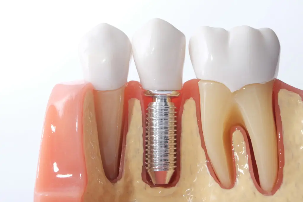 types of dental implants