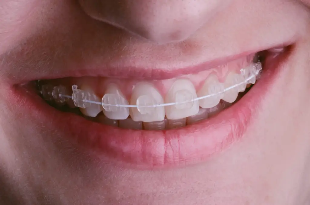 how to brush your teeth with braces