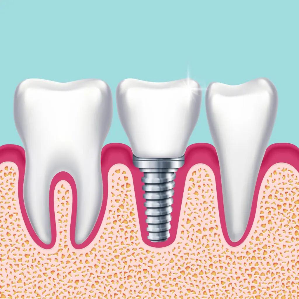 dental implant process