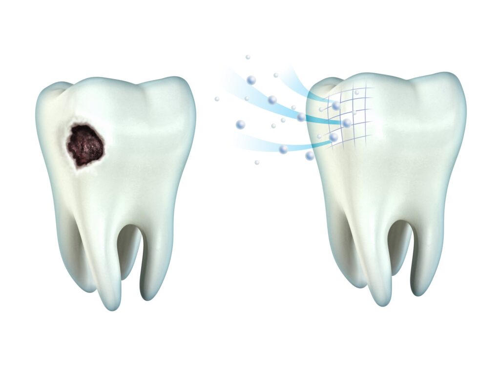 cavity in between teeth